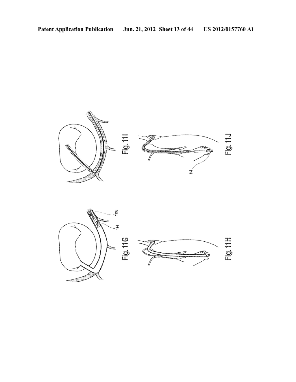 Tissue Restraining Devices and Methods of Use - diagram, schematic, and image 14