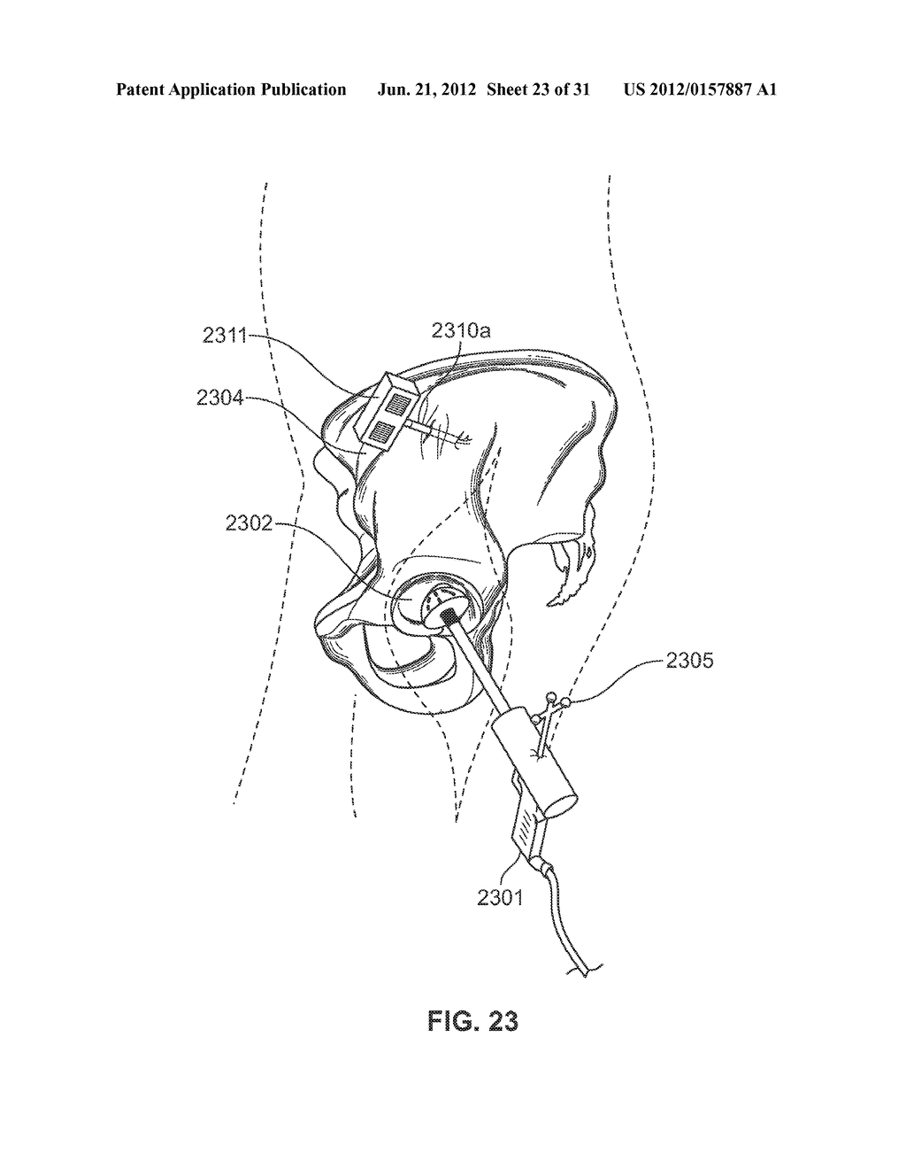 METHOD AND SYSTEM FOR ALIGNING A PROSTHESIS DURING SURGERY - diagram, schematic, and image 24