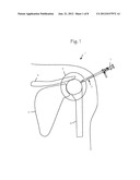 Anti-Extravasation Sheath diagram and image