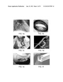 Selectable Eccentric Remodeling and/or Ablation of Atherosclerotic     Material diagram and image