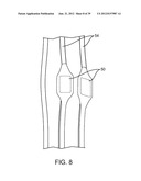 Selectable Eccentric Remodeling and/or Ablation of Atherosclerotic     Material diagram and image