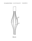 Selectable Eccentric Remodeling and/or Ablation of Atherosclerotic     Material diagram and image