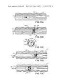 Selectable Eccentric Remodeling and/or Ablation of Atherosclerotic     Material diagram and image