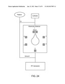 Selectable Eccentric Remodeling and/or Ablation of Atherosclerotic     Material diagram and image