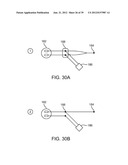 Selectable Eccentric Remodeling and/or Ablation of Atherosclerotic     Material diagram and image