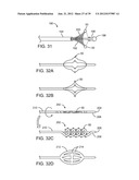 Selectable Eccentric Remodeling and/or Ablation of Atherosclerotic     Material diagram and image