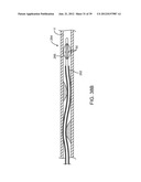 Selectable Eccentric Remodeling and/or Ablation of Atherosclerotic     Material diagram and image