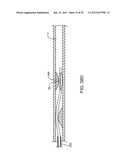 Selectable Eccentric Remodeling and/or Ablation of Atherosclerotic     Material diagram and image