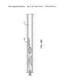 Selectable Eccentric Remodeling and/or Ablation of Atherosclerotic     Material diagram and image