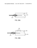 Selectable Eccentric Remodeling and/or Ablation of Atherosclerotic     Material diagram and image