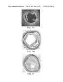 TUNED RF ENERGY FOR SELECTIVE TREATMENT OF ATHEROMA AND OTHER TARGET     TISSUES AND/OR STRUCTURES diagram and image