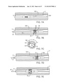 TUNED RF ENERGY FOR SELECTIVE TREATMENT OF ATHEROMA AND OTHER TARGET     TISSUES AND/OR STRUCTURES diagram and image