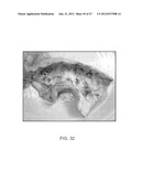 TUNED RF ENERGY FOR SELECTIVE TREATMENT OF ATHEROMA AND OTHER TARGET     TISSUES AND/OR STRUCTURES diagram and image