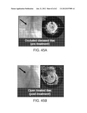 TUNED RF ENERGY AND ELECTRICAL TISSUE CHARACTERIZATION FOR SELECTIVE     TREATMENT OF TARGET TISSUES diagram and image