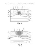 OFF-WALL ELECTRODE DEVICE FOR RENAL NERVE ABLATION diagram and image