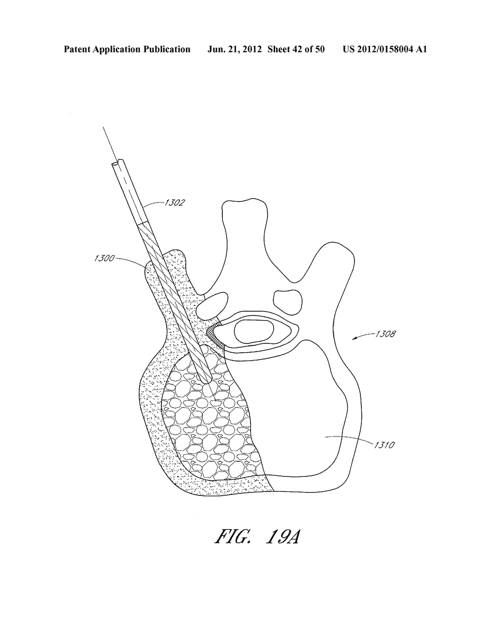 STEERABLE AND CURVABLE VERTEBROPLASTY SYSTEM WITH CLOG-RESISTANT EXIT     PORTS - diagram, schematic, and image 43