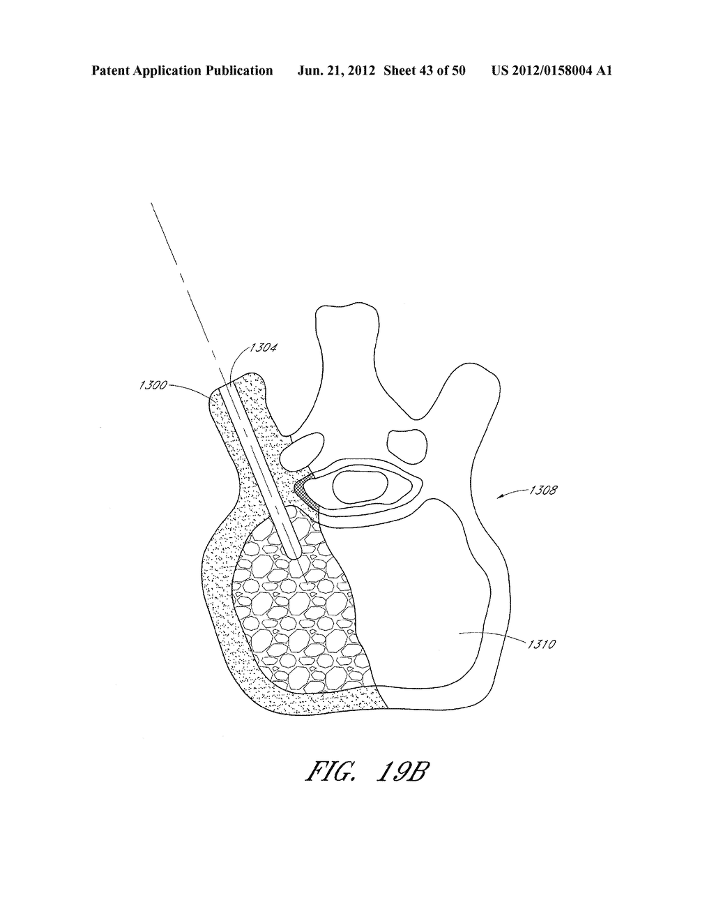 STEERABLE AND CURVABLE VERTEBROPLASTY SYSTEM WITH CLOG-RESISTANT EXIT     PORTS - diagram, schematic, and image 44