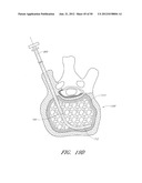 STEERABLE AND CURVABLE VERTEBROPLASTY SYSTEM WITH CLOG-RESISTANT EXIT     PORTS diagram and image