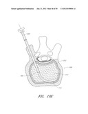 STEERABLE AND CURVABLE VERTEBROPLASTY SYSTEM WITH CLOG-RESISTANT EXIT     PORTS diagram and image