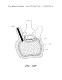 STEERABLE AND CURVABLE VERTEBROPLASTY SYSTEM WITH CLOG-RESISTANT EXIT     PORTS diagram and image