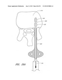 STEERABLE AND CURVABLE VERTEBROPLASTY SYSTEM WITH CLOG-RESISTANT EXIT     PORTS diagram and image