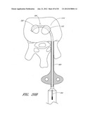 STEERABLE AND CURVABLE VERTEBROPLASTY SYSTEM WITH CLOG-RESISTANT EXIT     PORTS diagram and image