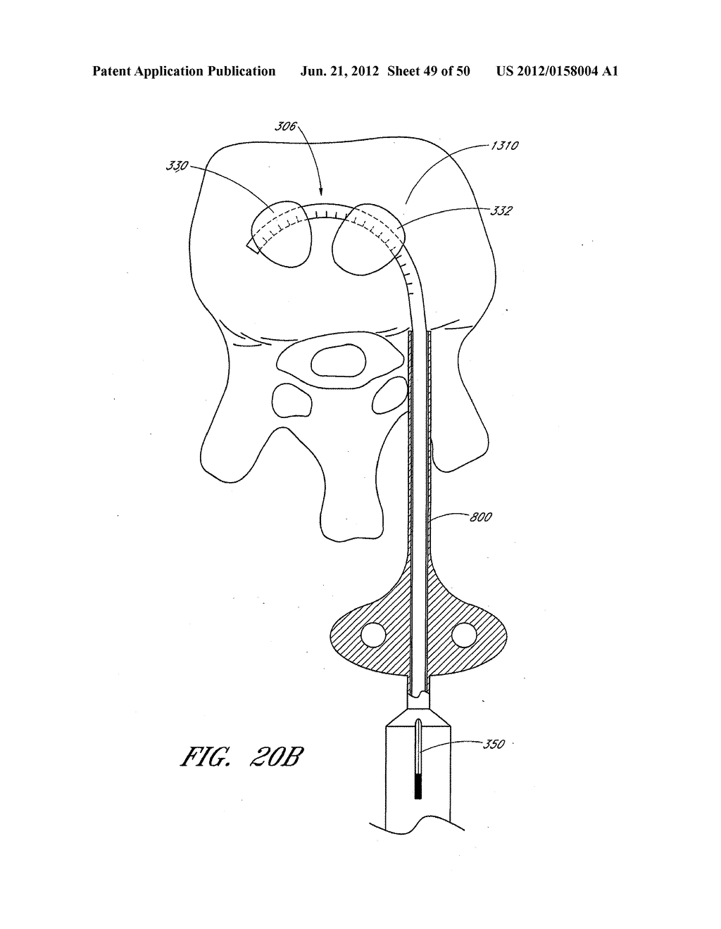 STEERABLE AND CURVABLE VERTEBROPLASTY SYSTEM WITH CLOG-RESISTANT EXIT     PORTS - diagram, schematic, and image 50