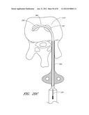 STEERABLE AND CURVABLE VERTEBROPLASTY SYSTEM WITH CLOG-RESISTANT EXIT     PORTS diagram and image