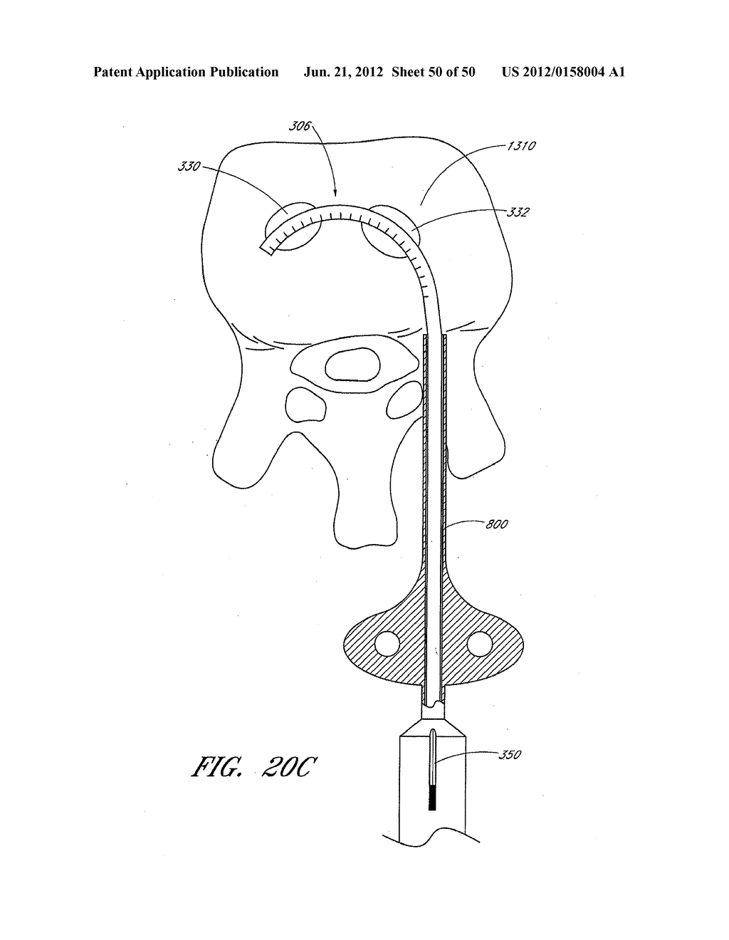 STEERABLE AND CURVABLE VERTEBROPLASTY SYSTEM WITH CLOG-RESISTANT EXIT     PORTS - diagram, schematic, and image 51