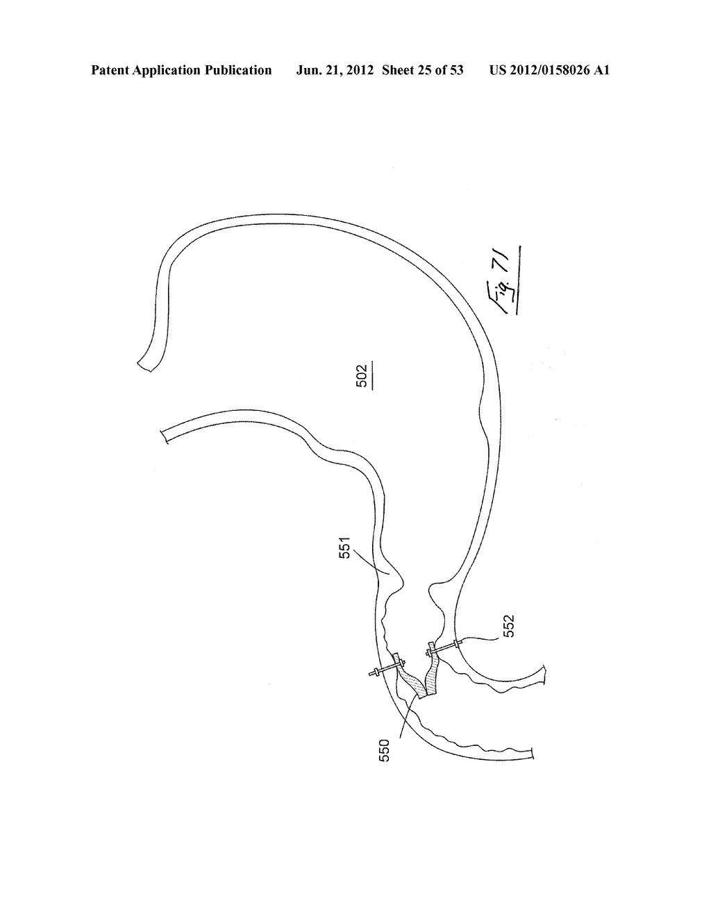 GASTROINTESTINAL IMPLANT DEVICE - diagram, schematic, and image 26