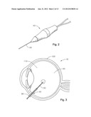 VITRECTOMY PROBE WITH ADJUSTABLE CUTTER PORT SIZE diagram and image