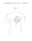 PACEMAKER WITH NO PRODUCTION diagram and image