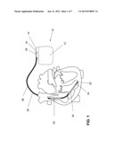 IMPLANTABLE DEVICE diagram and image