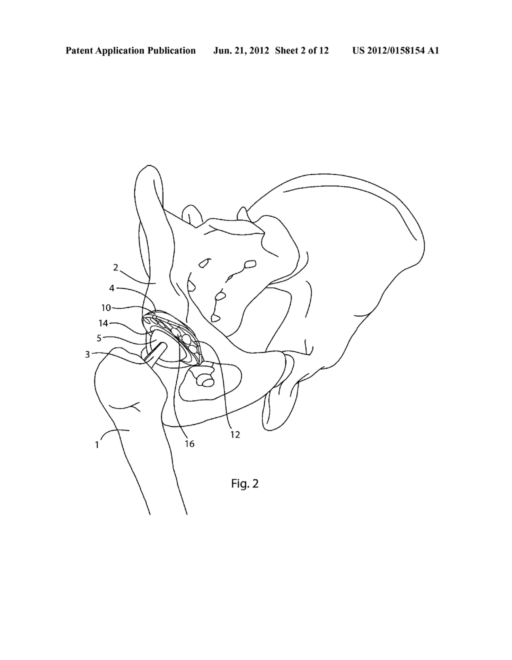 ACETABULAR CUP - diagram, schematic, and image 03