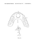 TONGUE ADVANCEMENT DEVICE FOR REDUCING OBSTRUCTIVE SLEEP APNEA CONDITION diagram and image