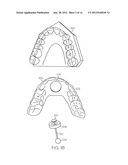 TONGUE ADVANCEMENT DEVICE FOR REDUCING OBSTRUCTIVE SLEEP APNEA CONDITION diagram and image