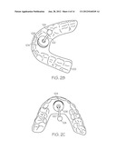 TONGUE ADVANCEMENT DEVICE FOR REDUCING OBSTRUCTIVE SLEEP APNEA CONDITION diagram and image