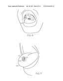 TONGUE ADVANCEMENT DEVICE FOR REDUCING OBSTRUCTIVE SLEEP APNEA CONDITION diagram and image