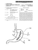 METHODS AND DEVICES FOR REDUCING GASTRIC VOLUME diagram and image