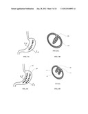 METHODS AND DEVICES FOR REDUCING GASTRIC VOLUME diagram and image