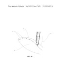 METHODS AND DEVICES FOR REDUCING GASTRIC VOLUME diagram and image