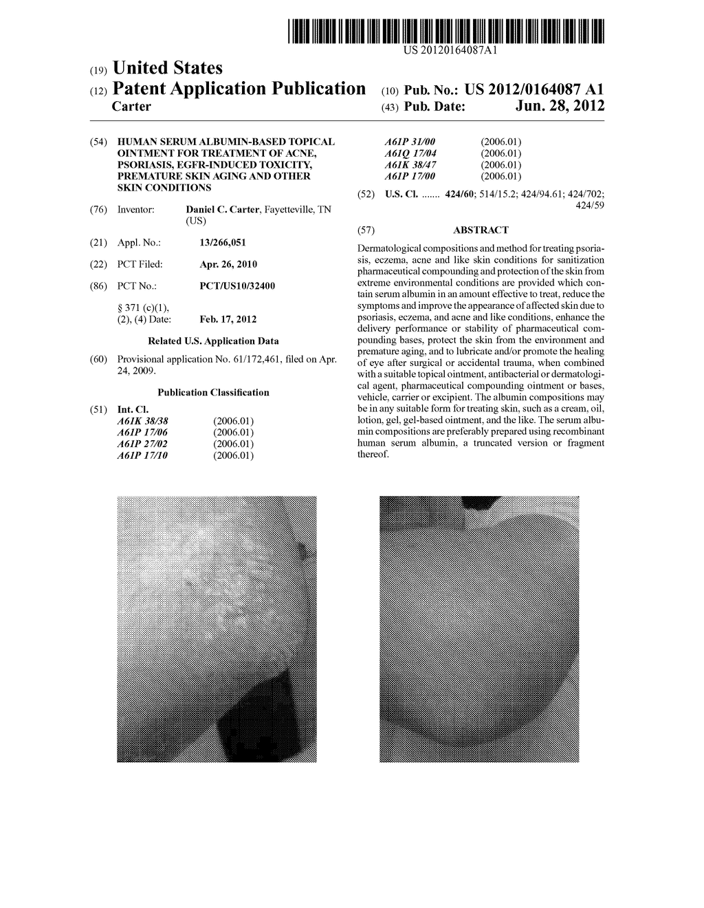 Human Serum Albumin-Based Topical Ointment for Treatment of Acne,     Psoriasis, Egfr-Induced Toxicity, Premature Skin Aging and Other Skin     Conditions - diagram, schematic, and image 01