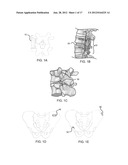 BONE GRAFT MATERIALS AND METHODS diagram and image