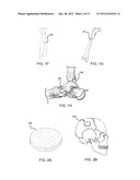 BONE GRAFT MATERIALS AND METHODS diagram and image