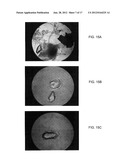 BONE GRAFT MATERIALS AND METHODS diagram and image