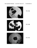 BONE GRAFT MATERIALS AND METHODS diagram and image