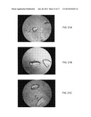 BONE GRAFT MATERIALS AND METHODS diagram and image