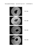 BONE GRAFT MATERIALS AND METHODS diagram and image