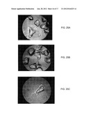 BONE GRAFT MATERIALS AND METHODS diagram and image