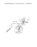 DENTAL IMPLEMENT HAVING LUMEN AND DISTAL THREADING diagram and image